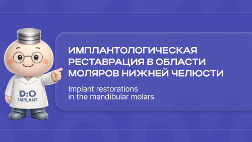 Установка имплантатов в области жевательной группы зубов нижней челюсти
